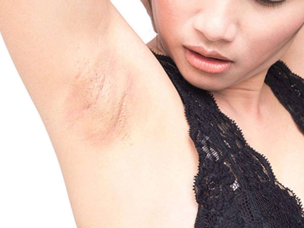 Your Dark Underarms Will Glow With These Home Remedies