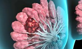 Breast Cancer Treatment New medicine will be available in India for the treatment of breast cancer, there will be no delay in treatment