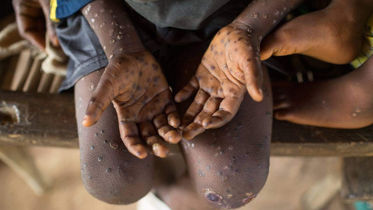 Monkeypox Virus is spreading in India too, know its symptoms and ways to avoid it