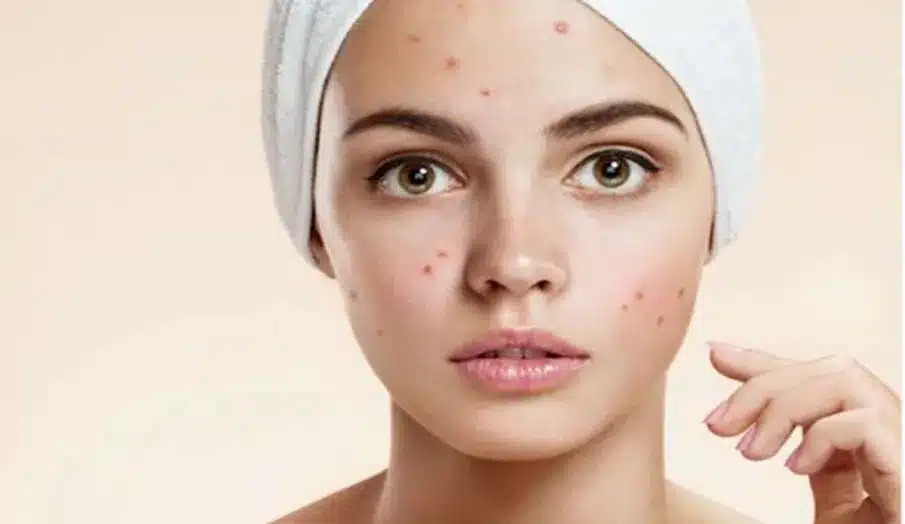 Apply multani mitti on the face like this, acne will disappear