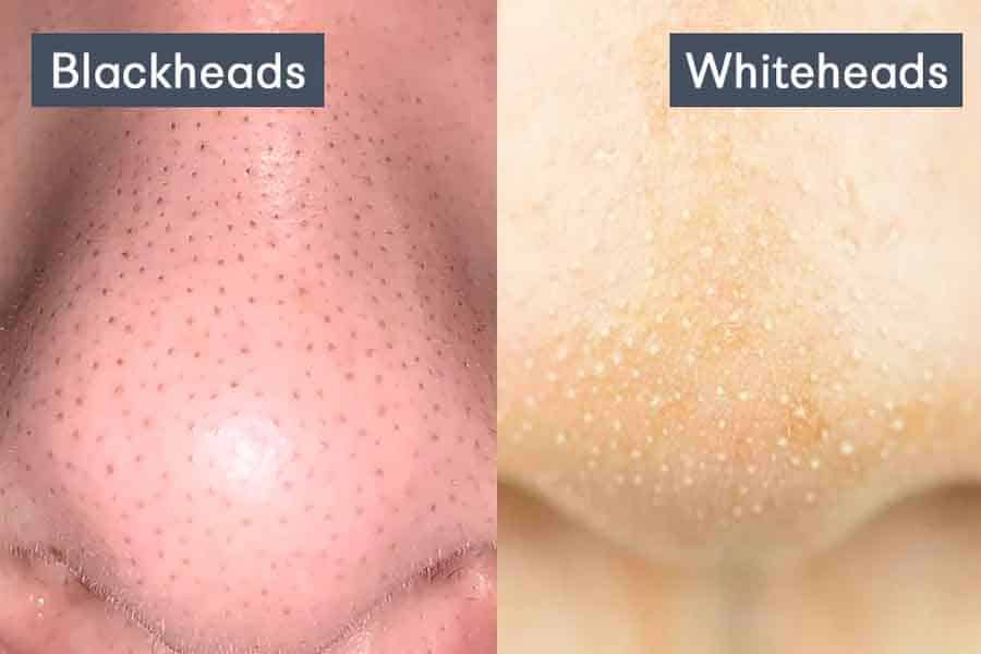 blackheads and whiteheads