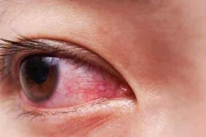 Eye Swelling And Redness