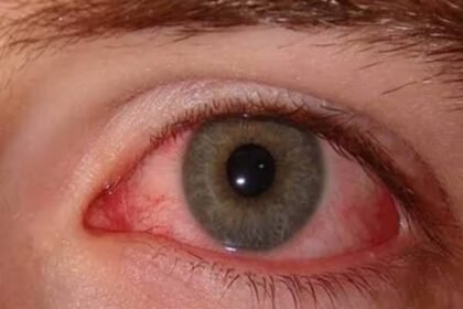 Jharkhand Eye flu infection spreading rapidly