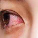 jamshedpur eye infection increasing MGM and Sadar Hospital 10 to 20 patients treated daily
