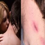 love bite