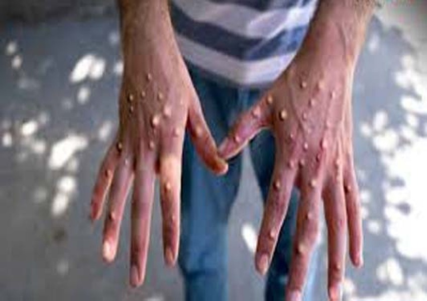 It is necessary for states and UTs to prepare at the district level regarding monkeypox, the Center has said…