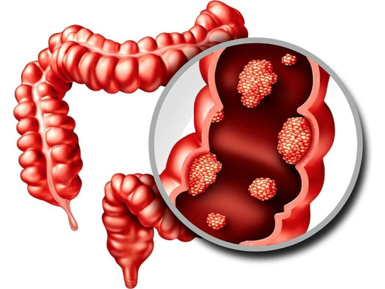 Increased risk of colorectal cancer