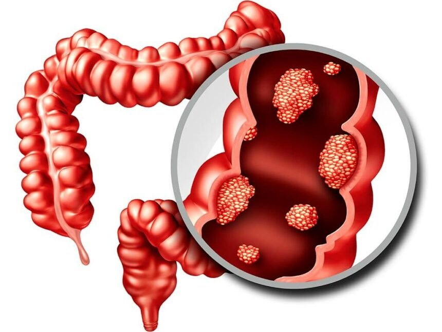 Increased risk of colorectal cancer