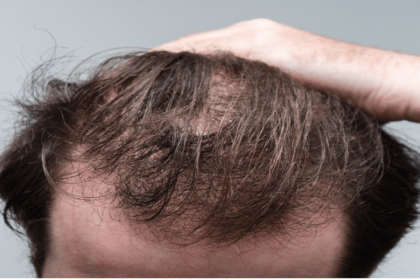 Ozempic, Semaglutide, Tirzepatide, Hair Loss, Diabetes