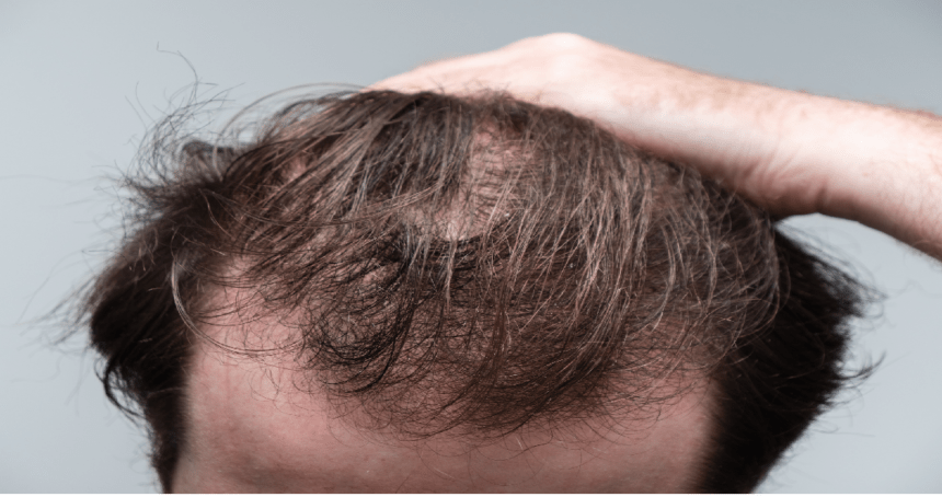 Ozempic, Semaglutide, Tirzepatide, Hair Loss, Diabetes